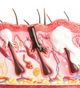 Types of Acne